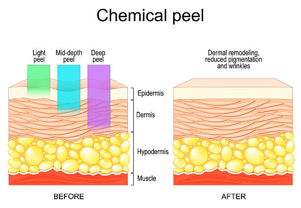 What Is Chemical Peel Treatment?