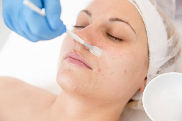 Who Is an Ideal Candidate for Chemical Peel Treatment?