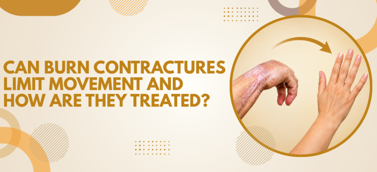 Can Burn Contractures Limit Movement and How Are They Treated?